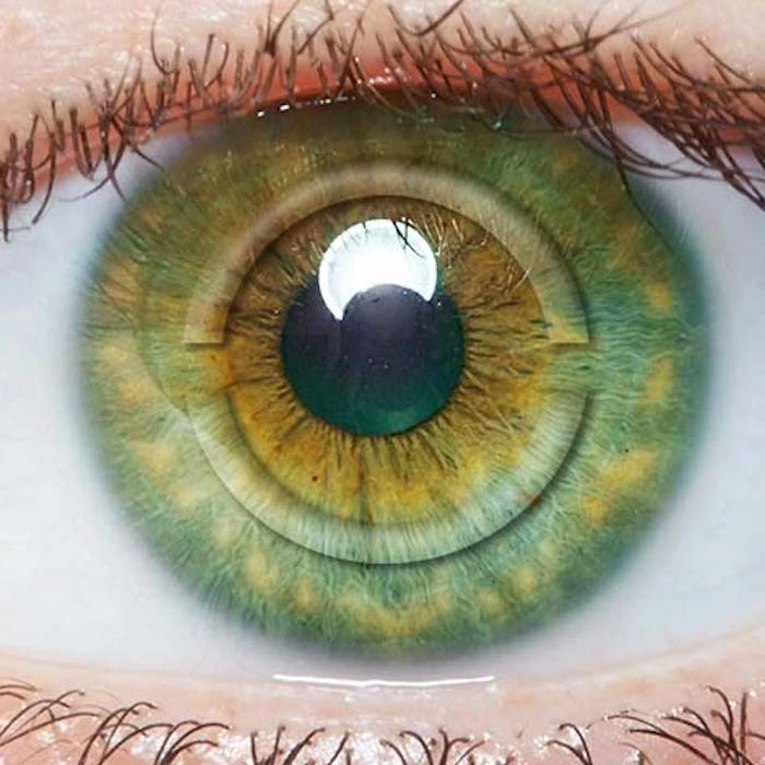 Intacs Corneal Inserts Or Implants – Proven Treatment For Keratoconus