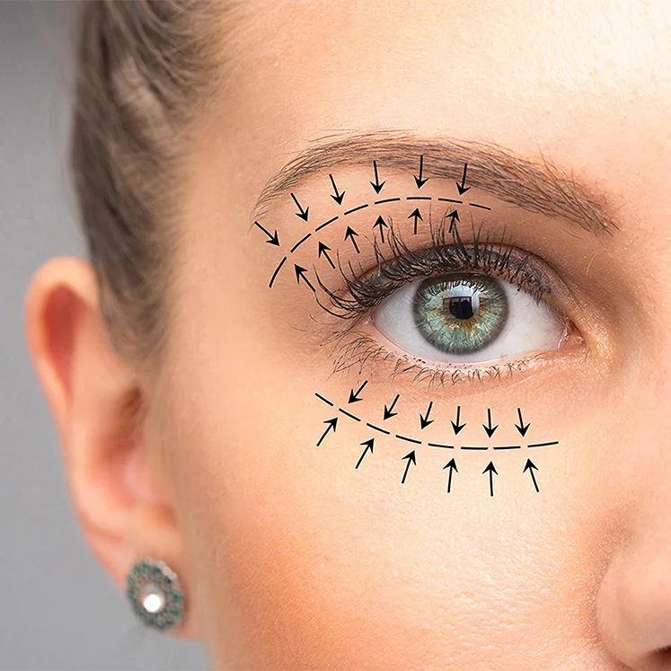 close up of woman's eyelid with markings for blepharoplasty procedure