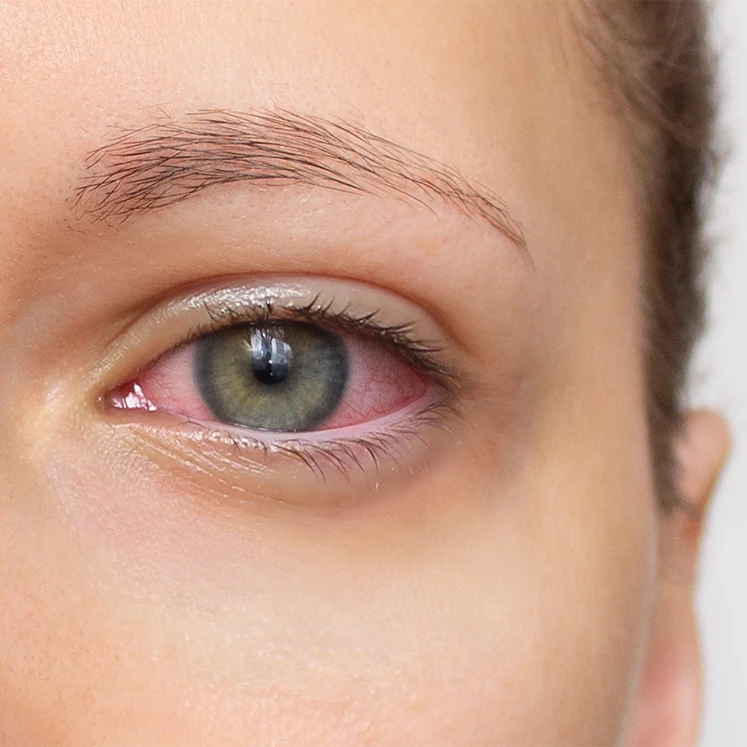 dry eye