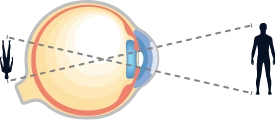 hyperopia illustration