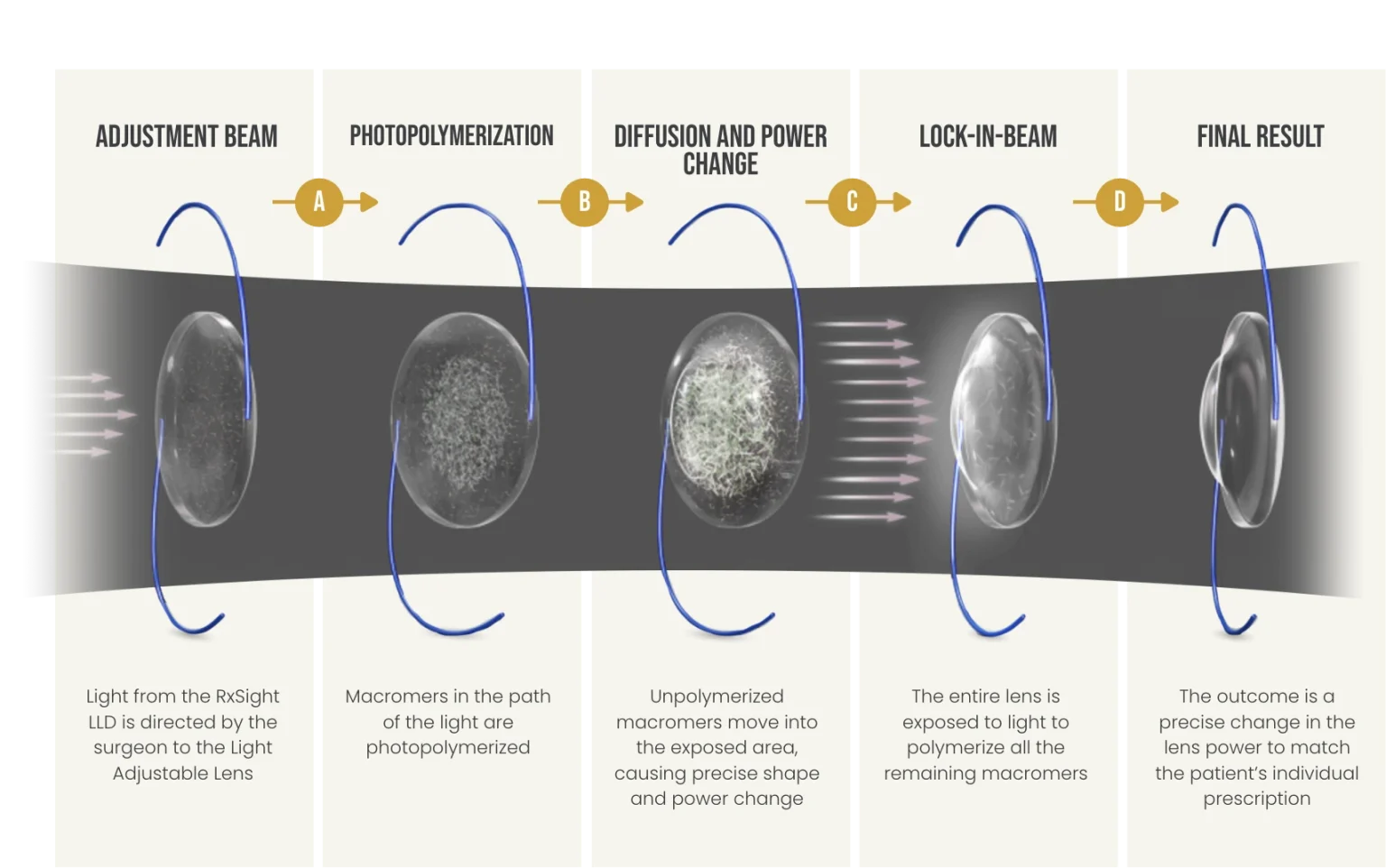 infograph showing the process of the light adjustable lens